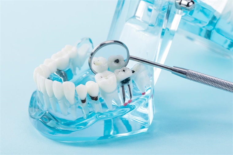 更便宜、更快捷！科学家发现一种廉价液体SDF 可预防蛀牙并防止蛀牙恶化